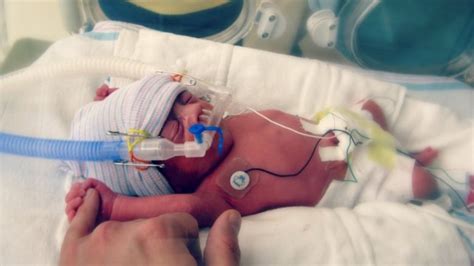 World Prematurity Day What To Expect As The Parent Of A Premature Baby