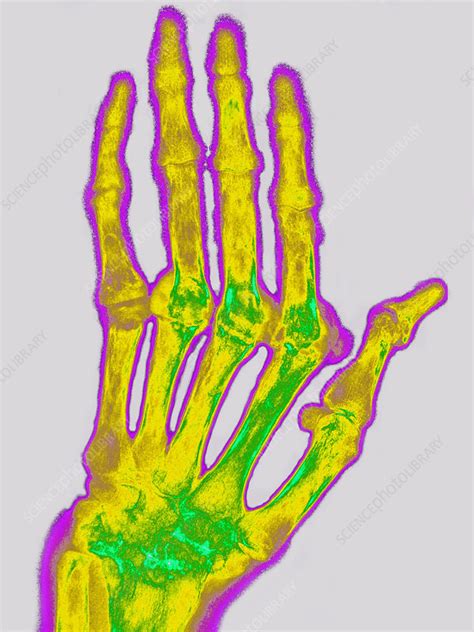 Rheumatoid arthritis is a systemic condition presenting as an inflammatory arthropathy. Rheumatoid Arthritis, X-ray - Stock Image - C027/2199 ...