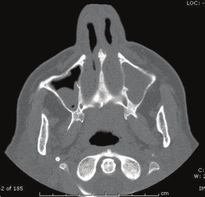 Ct Scanmucous Obliteration Of The Maxillary Sinus Complete In The Download Scientific Diagram
