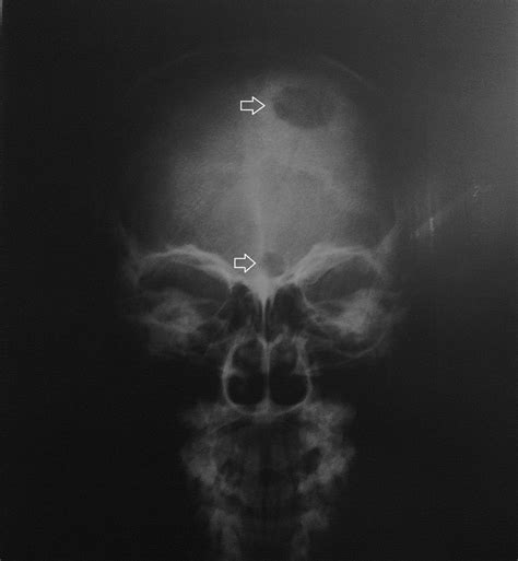 Disseminated Paracoccidioidomicosis Case 2 Cranial X Ray Showing