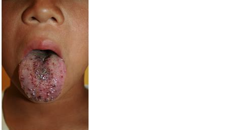 Transmucosal Bleomycin For Tongue Lymphatic Malformations