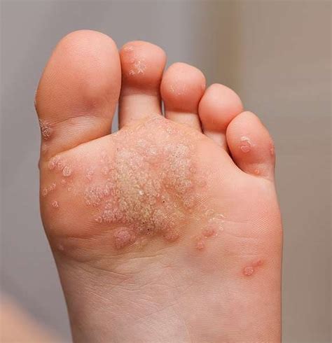 Warts And All What You Need To Know About Common Warts Central Texas