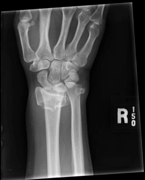 Intra Articular Distal Radius Fracture