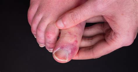 Covid Symptoms Rash On Toes Proactive Podiatrists Seeing Covid Toes