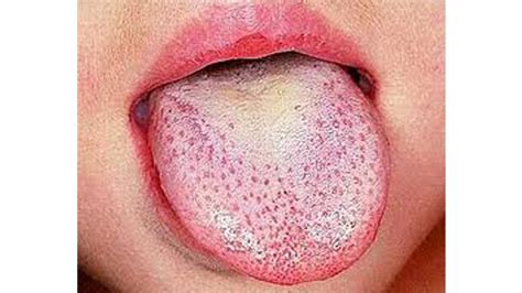 Scarlet Fever Dry Lips