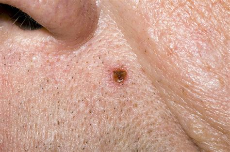 Basal Cell Carcinoma Stock Image M1310713 Science Photo Library