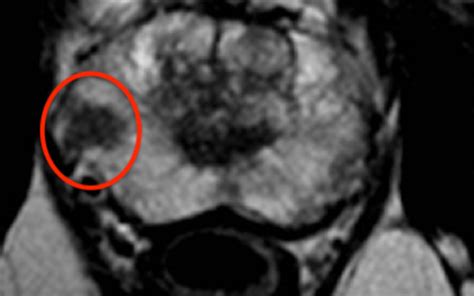 Or i'm not prepared to talk about that right now. NICE approval to use MRI for prostate cancer diagnosis ...