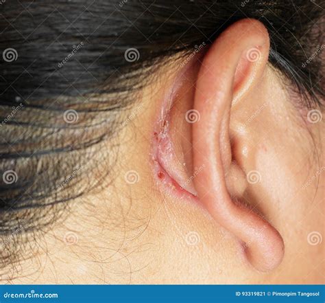 Wound Behind Ear Stock Image Image Of Blood Help Wound 93319821