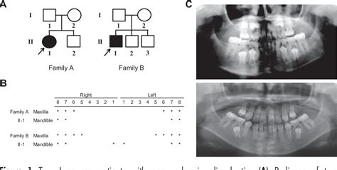 Figure 1 From Novel Pax9 Mutations Cause Non Syndromic Tooth Agenesis