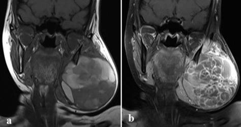 Enormous Aneurysmal Bone Cyst Of The Mandible Case Report And