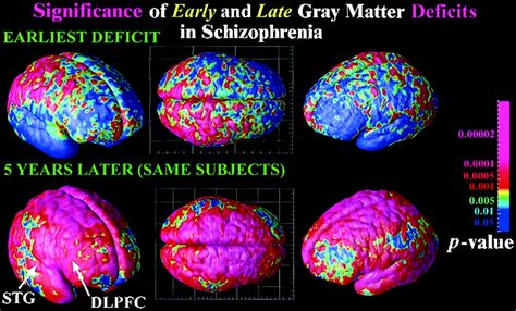 Mapping Adolescent Brain Change Reveals Dynamic Wave Of Accelerated