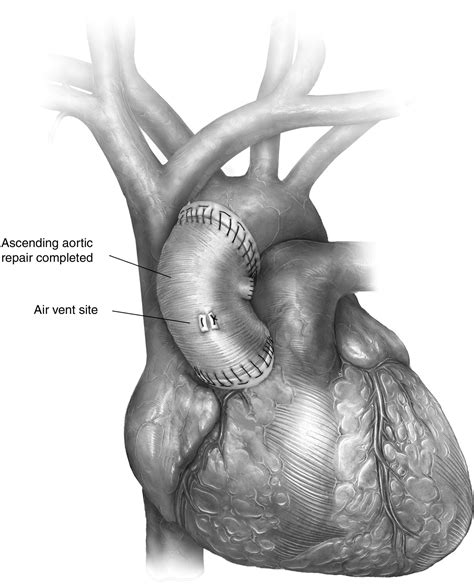 Acute Type A Aortic Dissection Operative Techniques In Thoracic And