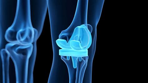 Total Knee Replacement Surgery London Bridge Orthopaedics