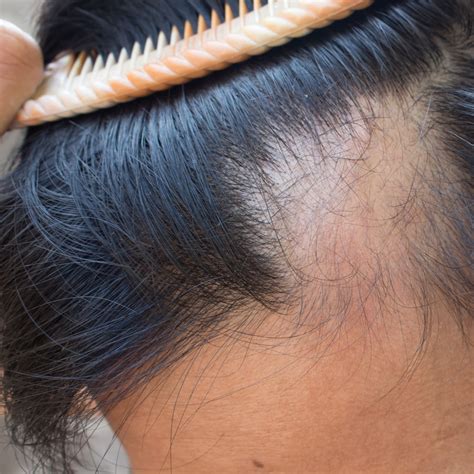 Best Dermatologist For Hair Loss Near Me Sales And Deals