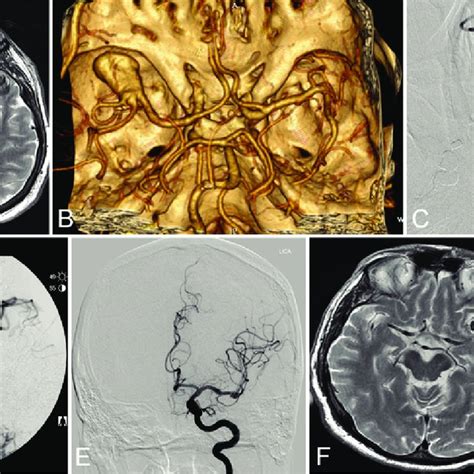 Case 23 A Axial T2 Weighted Mr Image Demonstrating A Large Left Mca