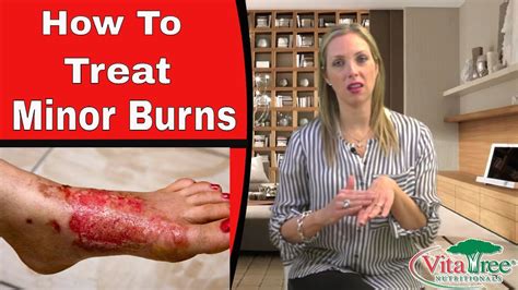 Here are 17 tips to help you treat a burn — no matter how you got the injury. Treating Burns Using Home Remedies - VitaLife Show Episode ...