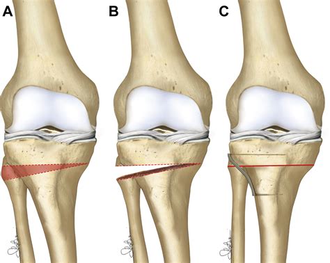 Lateral Closing Wedge High Tibial Osteotomy For Medial Compartment
