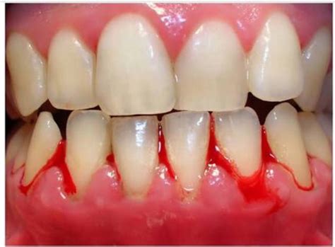 Read more to learn natural remedies. Bad Breath Treatment at Affordable Cost in Hyderabad ...