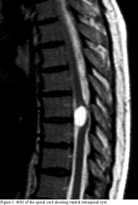 Intraspinal Neurenteric Cyst — A Rare Entity