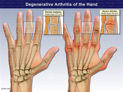 Degenerative Arthritis Of The Hand Trialexhibits Inc