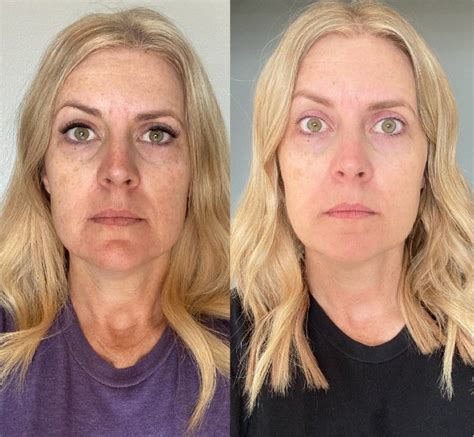 Collagen Before And After Pictures Hot Sex Picture