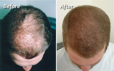 Surgical And Non Surgical Hair Restoration Options