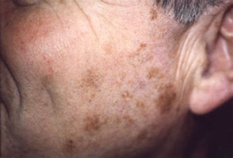 Research For Old Age Project Age Spots Or Liver Spots Age Spots On