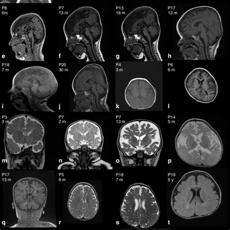 Brain Magnetic Resonance Image Mri Of Individuals With Wwox Related Download Scientific