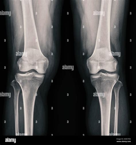 Film X Ray Both Knee Joint Ap View Showing Normal Knee Joint Stock
