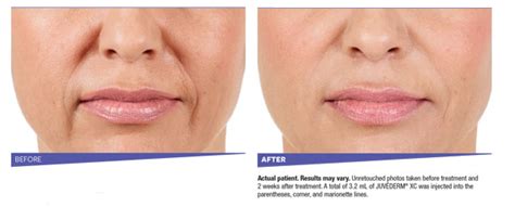 JuvÉderm® Cibolo Creek Dermatology Group