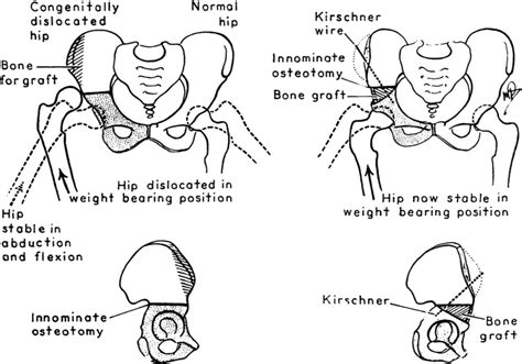 Innominate Osteotomy 10 The Base Of The Triangular Bone Graft Taken