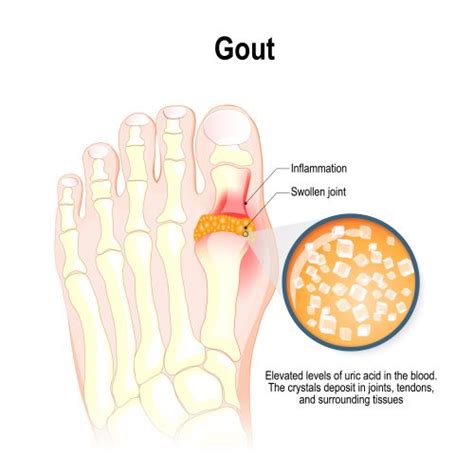 Human 3d Cell Based Systems To Research Gout Drug Target Review
