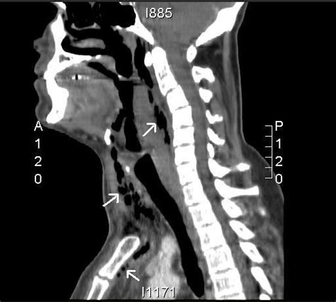 Sagittal Reconstruction Of Ct Of The Neck And Upper Med Open I