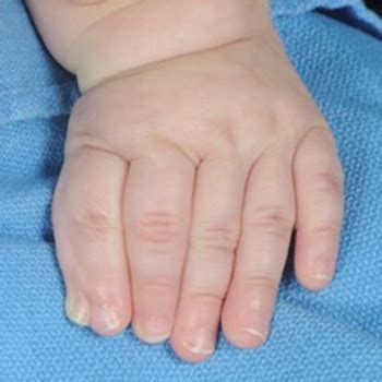 Polydactyly Extra Fingers Or Toes And Corrective Surgery Hss