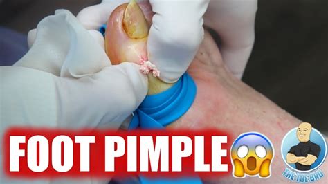 Popping A Huge Bump On A Big Toe Warning Super Explosive