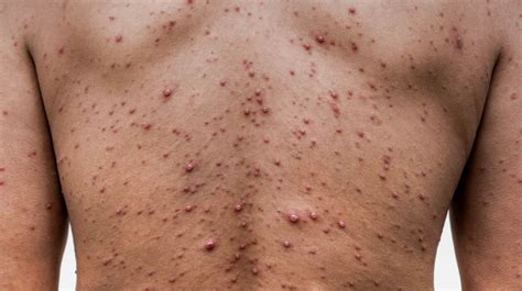 Everything You Need To Know About Viral Rashes Recipe Ideas Product