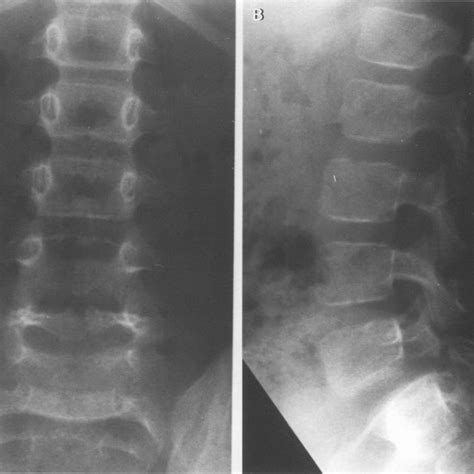 A Anteroposterior And B Lateral Radiographs Of The Lumbar Spine