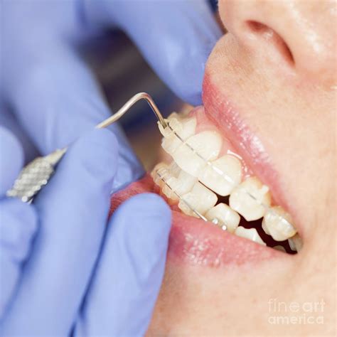 Orthodontist Tightening Braces Photograph By Microgen Images Science Photo Library Fine Art