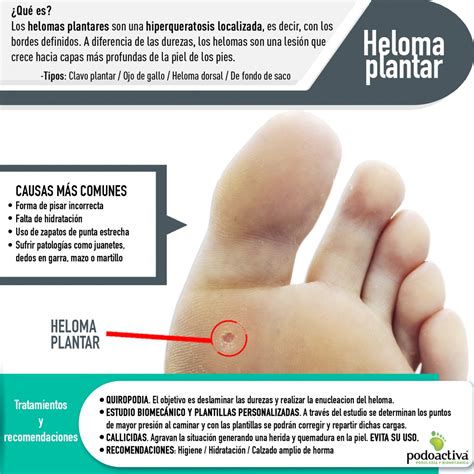 Ojo de gallo en el pie heloma plantar y dorsal Tratamiento y prevención