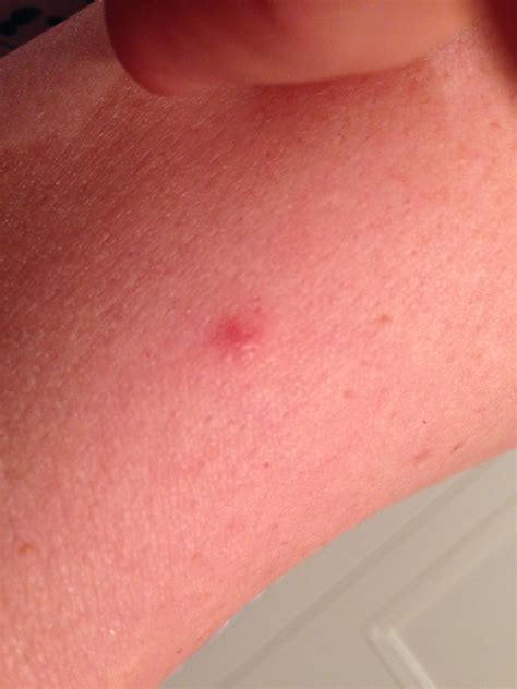 Red Spot Skin Cancer On Arm