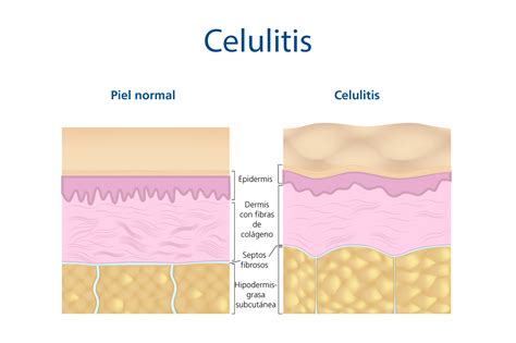 Celulitis Infecciosa Tipos Causas Y Tratamiento Kulturaupice Hot Sex Picture