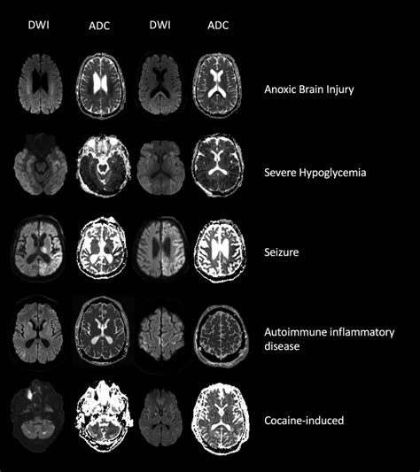 Neuroimaging Mimics Of Anoxic Brain Injury A Review Mason Sharma