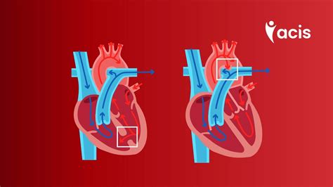 Cursocardiopatías Congénitas Del Niño Y Cardiopatías Del Adulto