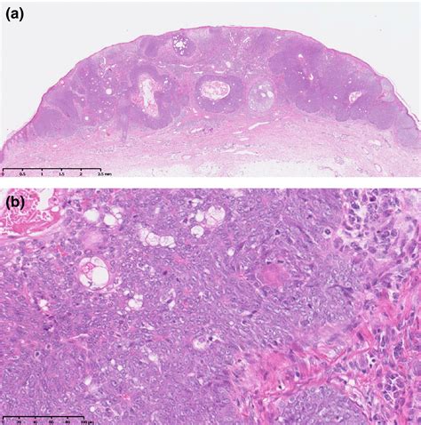 Sweat Gland Cyst In Lip