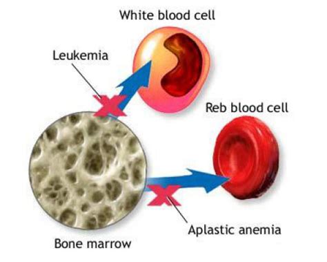 All You Need To Know About Aplastic Anemia Or Bone Marrow Failure