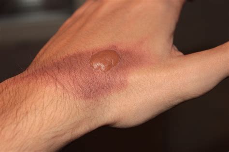 Essential Facts About Different Types Of Burns And How To Treat Them