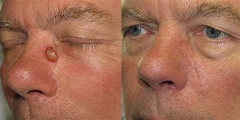 Nose Reconstruction Gallery Skin Cancer And