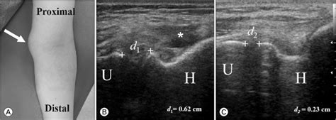 Patient 2 A Photograph Of Left Elbow Shows Focal Swelling White