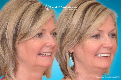 Hurts my lower teeth to do it. Overbite Correction and Bad Porcelain Veneers Replaced ...