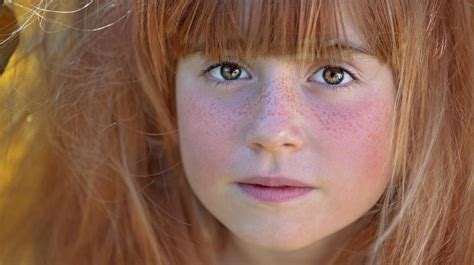 Skin Cancer Risk For Freckly Red Heads Equivalent To 21 Years In Sun